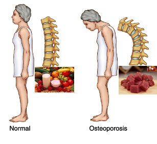 Cibi benefici e cibi da evitare per prevenire e contrastare l'osteoporosi ossea