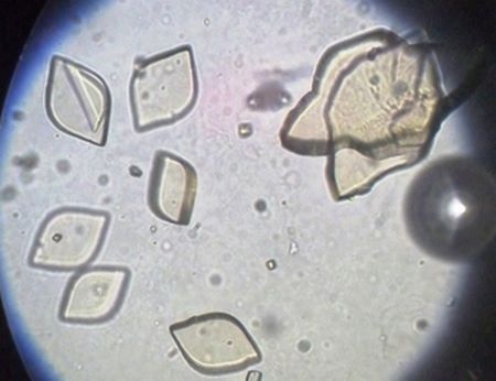 Cristalli di acidi urici ingranditi al microscopio