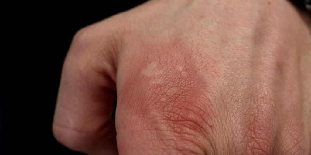 Mano punta da una vespa