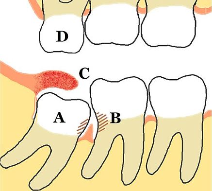 Disegno di pericoronarite dentale con dente che spinge su altri