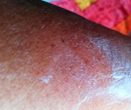 Pelle infiammata trattata con crema Prep