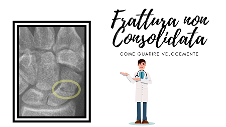 Disegno di medico accanto a immagine di frattura non consolidata