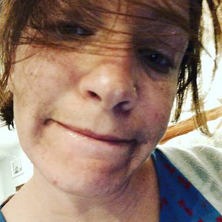 Ragazzina con maskne sul viso