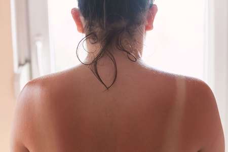 Schiena femminile dalla pelle scottata dal sole
