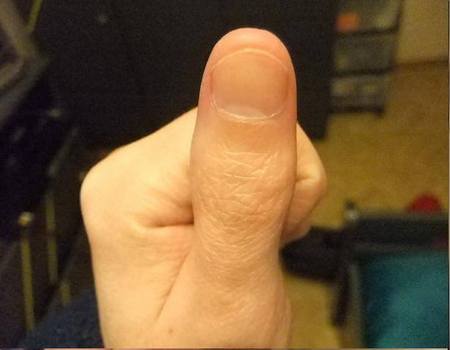 Unghia costituita da lamina ungueale, letto ungueale, lunula e matrice ungueale